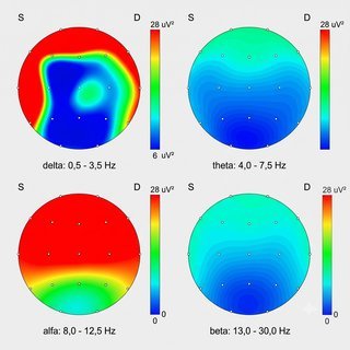 EEG mapping &mdash; alpha