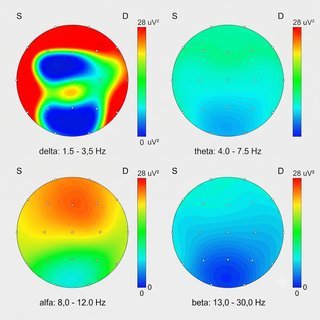EEG mapping &mdash; delta